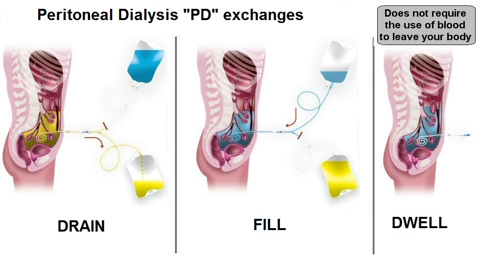 the-virtual-nephrologist-peritoneal-dialysis-PD